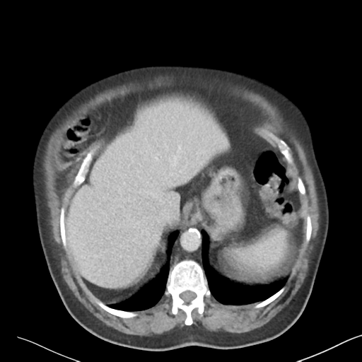 File:Bladder papillary urothelial carcinoma (Radiopaedia 48119-52951 Axial 6).png