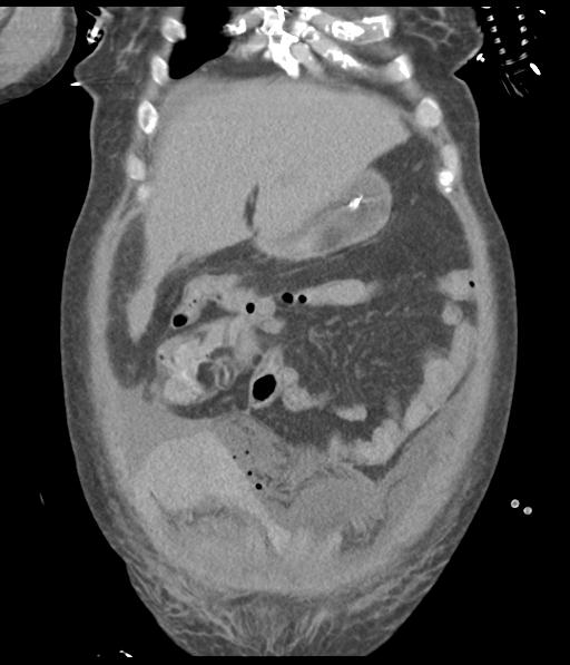 Bladder rupture post renal biopsy (Radiopaedia 30863-31572 Coronal non-contrast 17).jpg
