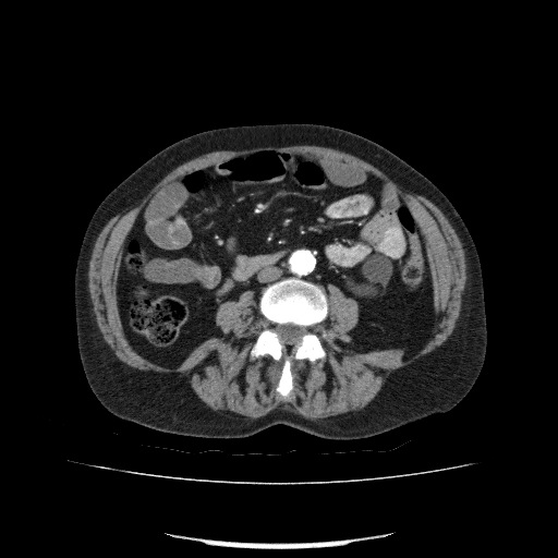 File:Bladder tumor detected on trauma CT (Radiopaedia 51809-57609 A 126).jpg