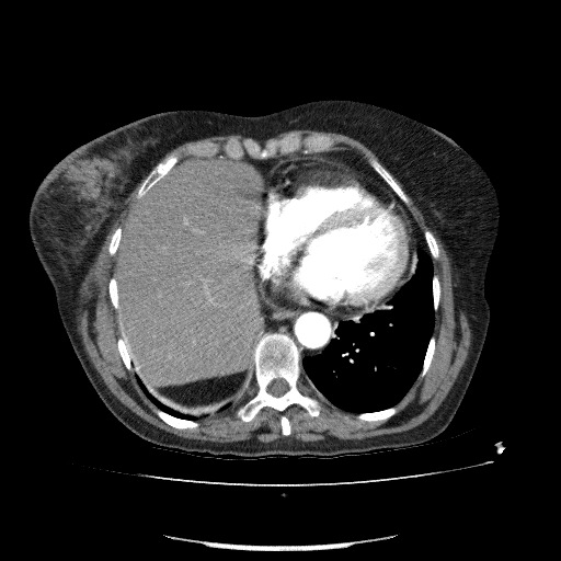 Bladder tumor detected on trauma CT (Radiopaedia 51809-57609 A 65).jpg