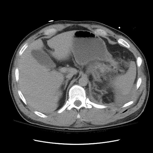 Blunt abdominal trauma with solid organ and musculoskelatal injury with active extravasation (Radiopaedia 68364-77895 Axial C+ delayed 34).jpg
