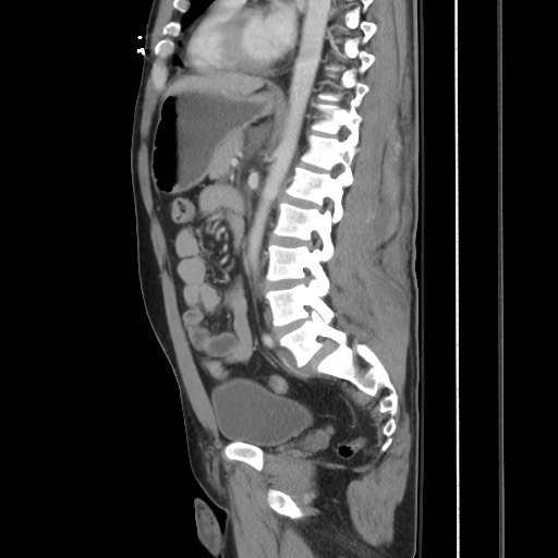Blunt abdominal trauma with solid organ and musculoskelatal injury with active extravasation (Radiopaedia 68364-77895 C 84).jpg