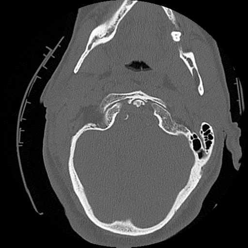 File:Blunt cerebrovascular injury (Radiopaedia 53682-59743 Axial bone window 13).png