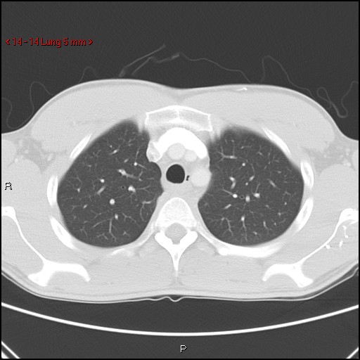 Blunt chest trauma - pulmonary interstitial emphysema and pneumomediastinum (Radiopaedia 20666-20552 Axial lung window 14).jpg