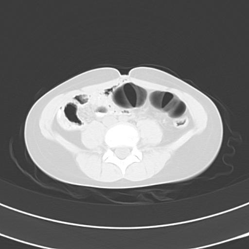 File:Bochdalek diaphragmatic hernia (Radiopaedia 38866-41059 Axial lung window 37).jpg