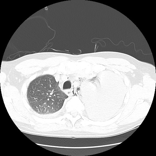 Boerhaave syndrome (Radiopaedia 59796-67310 Axial lung window 18).jpg