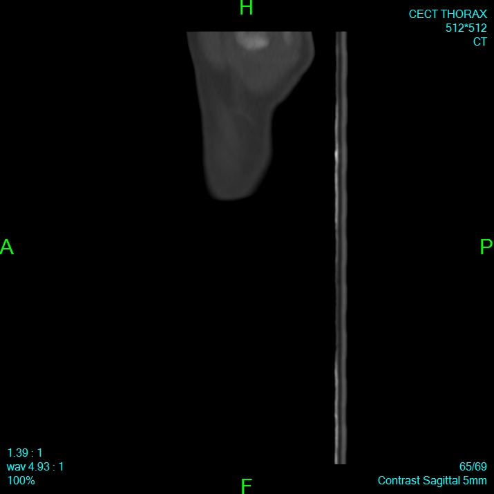 Bone metastases from lung carcinoma (Radiopaedia 54703-60937 Sagittal bone window 65).jpg
