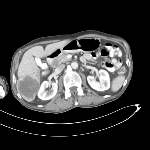 Bone metastasis from squamous cell carcinoma (Radiopaedia 30133-30730 B 27).jpg