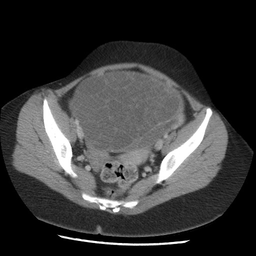 Borderline mucinous tumor (ovary) (Radiopaedia 78228-90808 A 123).jpg