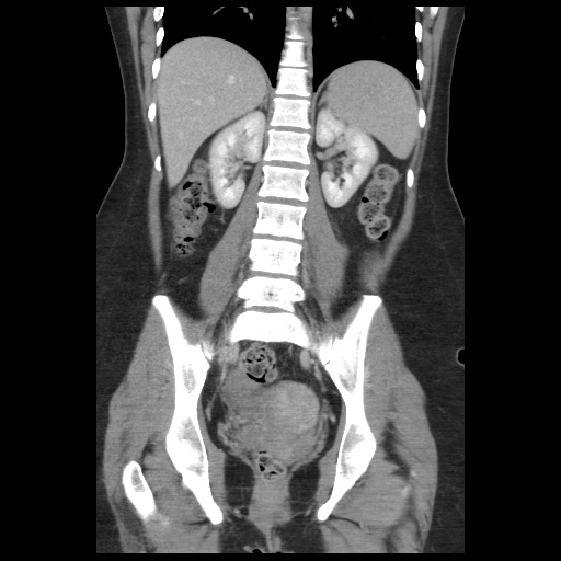 Borderline mucinous tumor (ovary) (Radiopaedia 78228-90808 C 34).jpg