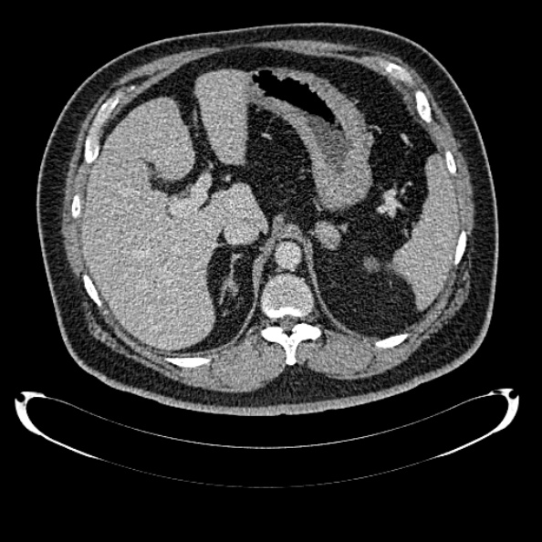 Bosniak renal cyst - type IV (Radiopaedia 24244-24518 C 71).jpg
