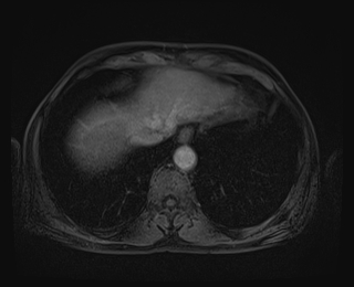 File:Bouveret syndrome (Radiopaedia 61017-68856 Axial T1 C+ fat sat 8).jpg