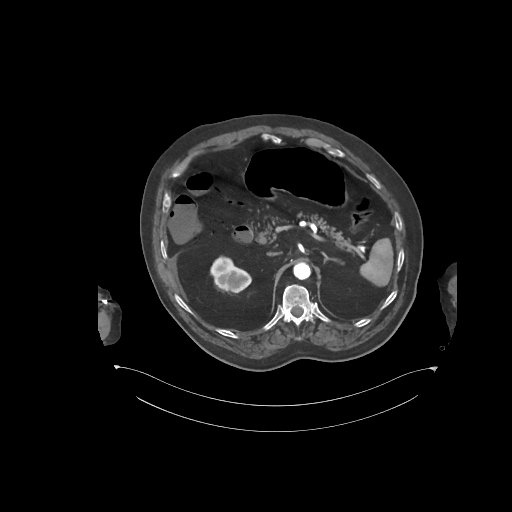 File:Bowel ischemia secondary to SMA occlusion with extensive portomesenteric venous gas (Radiopaedia 54656-60871 A 54).jpg