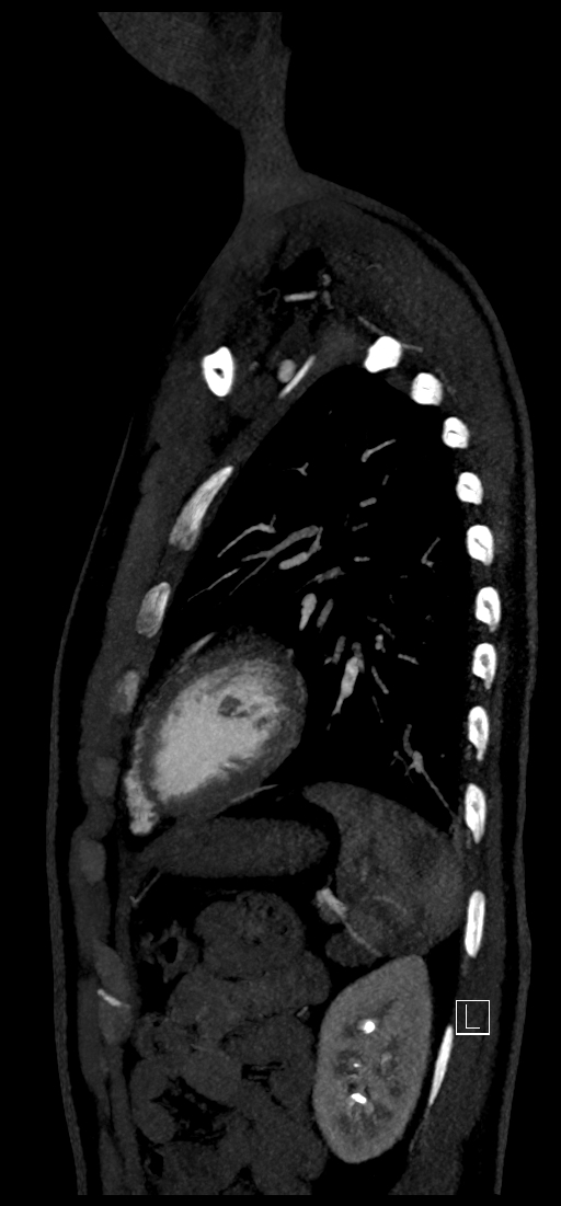 Brachiocephalic trunk pseudoaneurysm (Radiopaedia 70978-81191 C 72).jpg