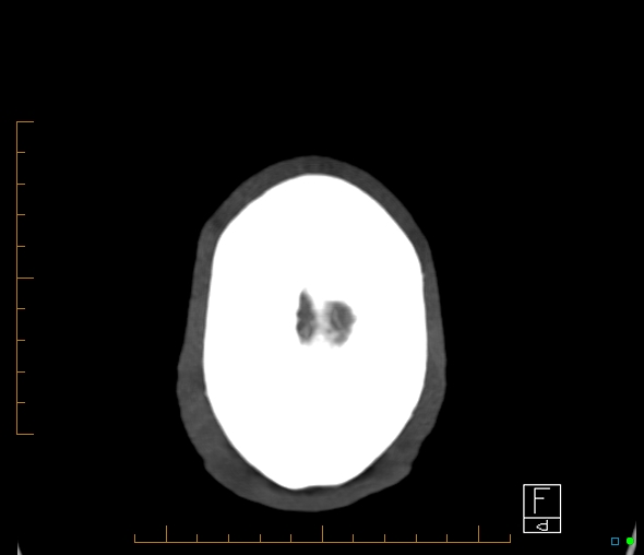 File:Brachiocephalic trunk stenosis (Radiopaedia 87242-103519 A 1).jpg
