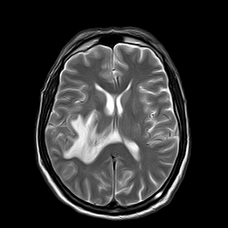 File:Brain abscess complicated by intraventricular rupture and ventriculitis (Radiopaedia 82434-96571 Axial T2 14).jpg