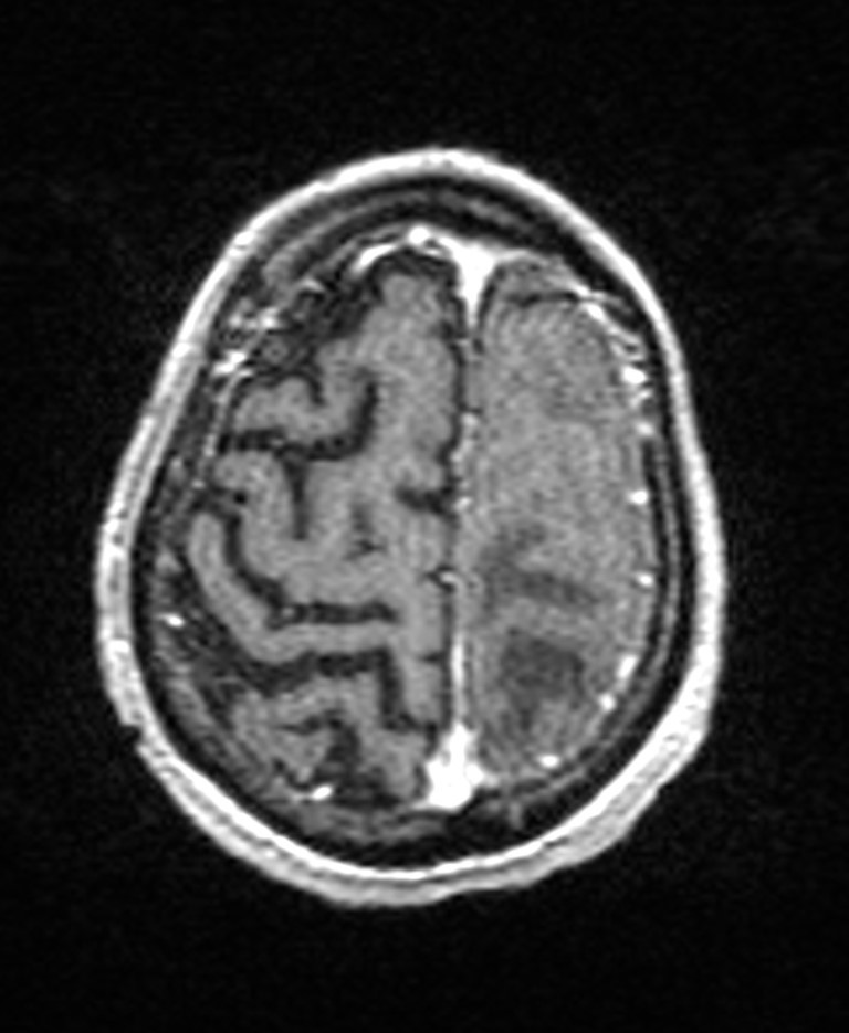 Brain abscess with dual rim sign (Radiopaedia 87566-103938 Axial T1 C+ 136).jpg