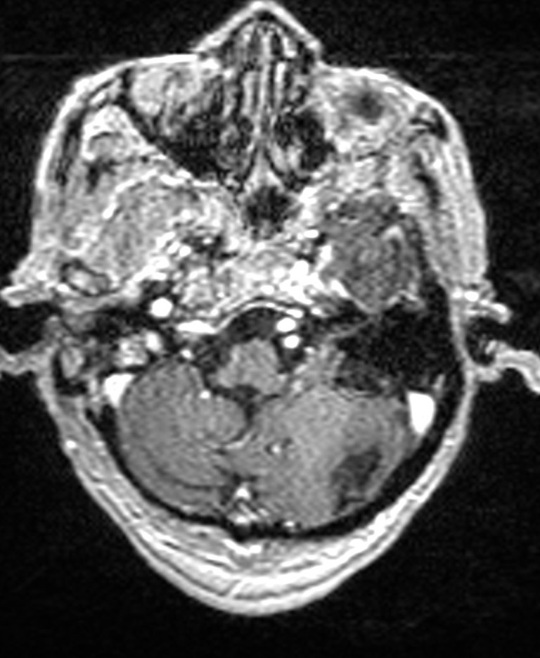 Brain abscess with dual rim sign (Radiopaedia 87566-103938 Axial T1 C+ 38).jpg