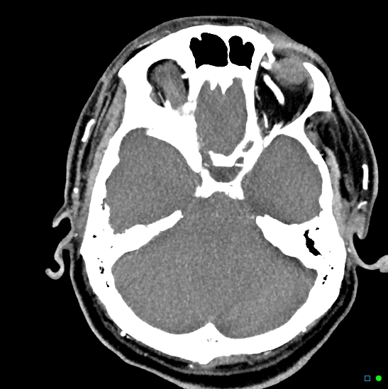 Brain death on MRI and CT angiography (Radiopaedia 42560-45841 B 36).jpg