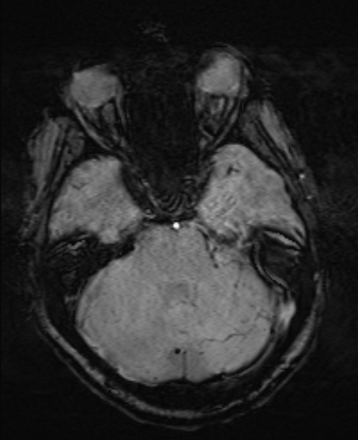 Brain metastases - lung cancer primary (Radiopaedia 75060-86115 Axial SWI 19).jpg