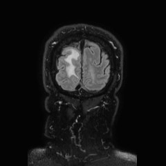 Brain metastases from lung cancer (Radiopaedia 83839-99028 Coronal FLAIR 78).jpg