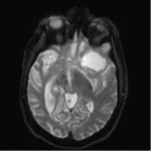 Brain metastasis (lung cancer) (Radiopaedia 48289-53179 Axial DWI 12).png