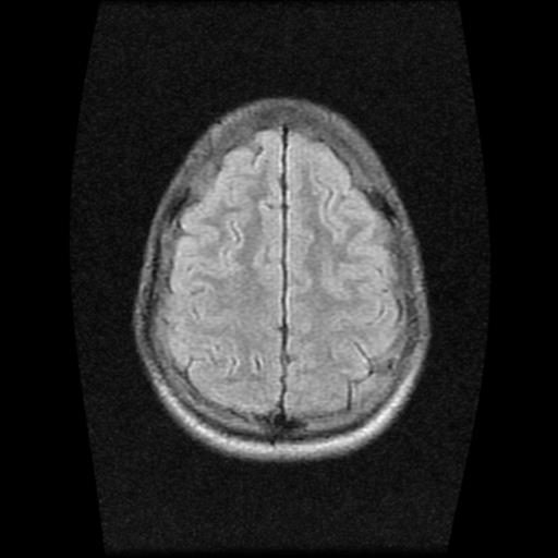 File:Brainstem glioma (Radiopaedia 30923-31624 Axial FLAIR 19).jpg
