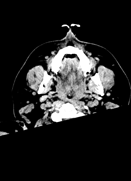 Brainstem hemorrhage (Radiopaedia 81294-94976 Axial non-contrast 73).jpg