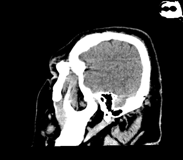 Brainstem hemorrhage (Radiopaedia 81294-94976 C 8).jpg