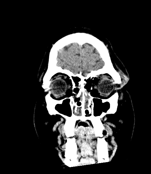 Brainstem hemorrhage (Radiopaedia 81294-94976 Coronal non-contrast 9).jpg