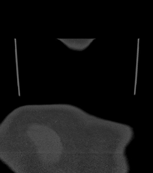 Branchial cleft cyst (Radiopaedia 31167-31875 Coronal bone window 70).jpg
