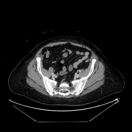 File:Breast cancer pseudocirrhosis with lobar invovlement (Radiopaedia 81080-94670 A 122).jpg