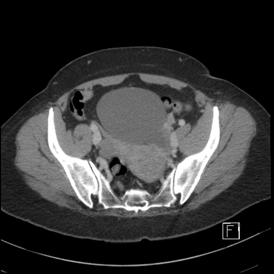 Breast metastases from renal cell cancer (Radiopaedia 79220-92225 C 93).jpg