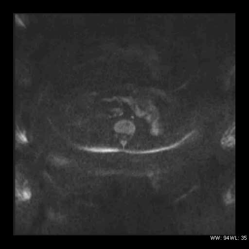 File:Broad ligament fibroid (Radiopaedia 49135-54241 Axial DWI 2).jpg