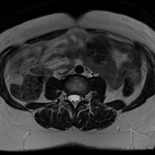 File:Broad ligament fibroid (Radiopaedia 49135-54241 Axial T2 1).jpg