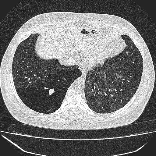 File:Bronchial atresia (Radiopaedia 58271-65417 Axial lung window 37).jpg