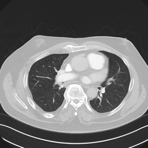 File:Bronchiectasis (Radiopaedia 39385-41666 Axial lung window 33).png
