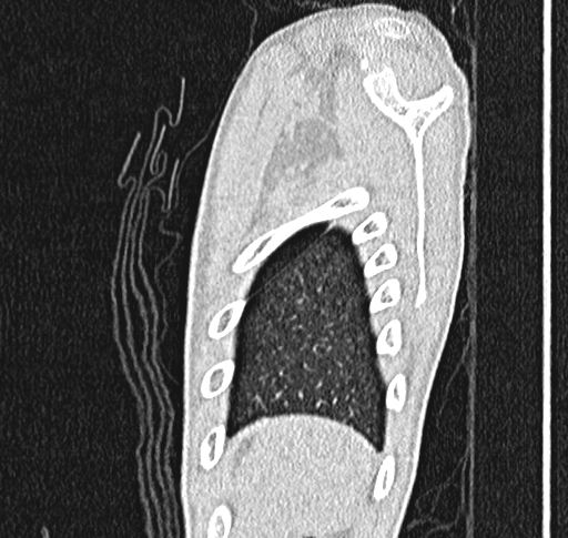 Bronchiolitis obliterans (Radiopaedia 71538-81897 Sagittal lung window 66).jpg