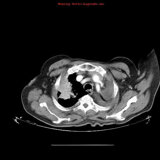 File:Bronchioloalveolar carcinoma (Radiopaedia 9272-9955 A 5).jpg
