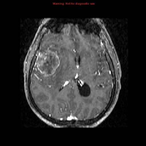File:Bronchogenic carcinoma brain metastasis (Radiopaedia 9286-9969 Axial T1 C+ 6).jpg