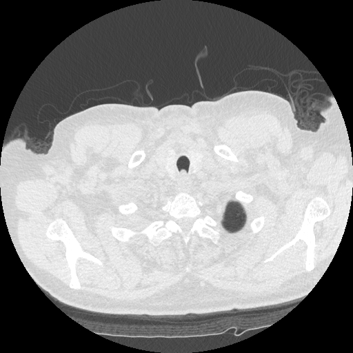 Bronchogenic carcinoma with metastatic lymphadenopathy (Radiopaedia 37671-39569 Axial lung window 5).jpg