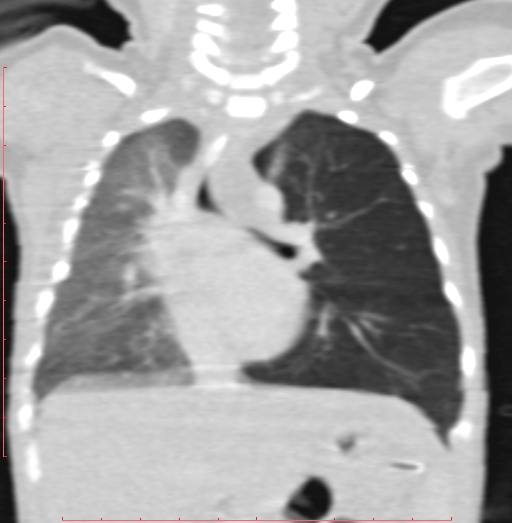 Bronchogenic cyst (Radiopaedia 78599-91409 Coronal lung window 124).jpg