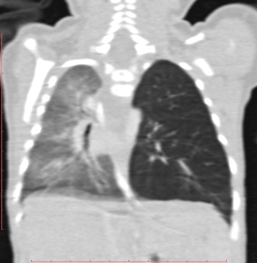 Bronchogenic cyst (Radiopaedia 78599-91409 Coronal lung window 146).jpg