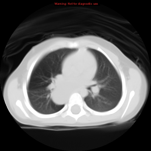 File:Bronchogenic cyst (Radiopaedia 9372-10063 Axial lung window 8).jpg