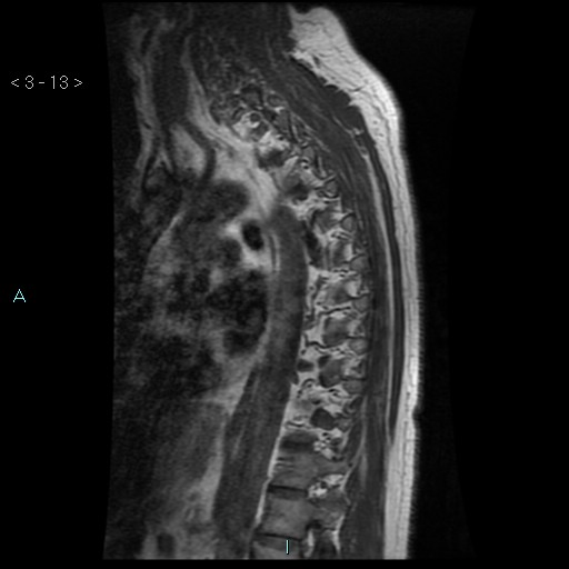 File:Bronchogenic cyst - posterior mediastinal (Radiopaedia 43885-47365 Sagittal T1 13).jpg