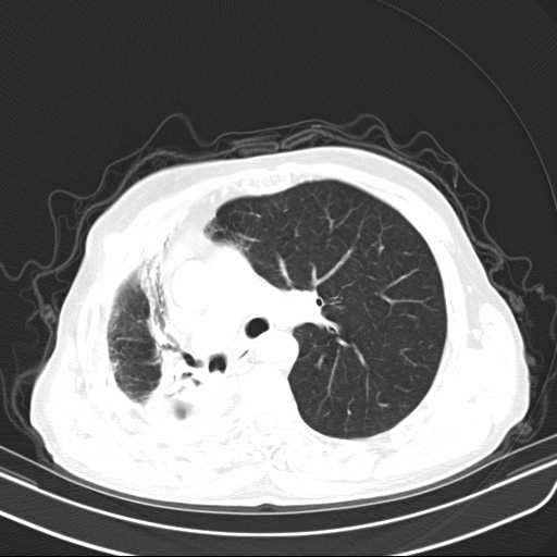 Bronchopleural fistula - postoperative complication (Radiopaedia 21020-20947 Axial lung window 22).jpg