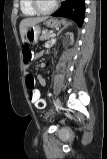 Brown tumors compressing the spinal cord (Radiopaedia 68442-77988 F 35).jpg