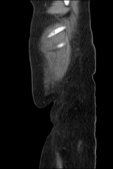 Brown tumors compressing the spinal cord (Radiopaedia 68442-77988 F 55).jpg