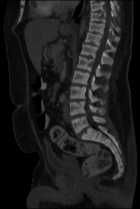 Brown tumors compressing the spinal cord (Radiopaedia 68442-77988 H 29).jpg