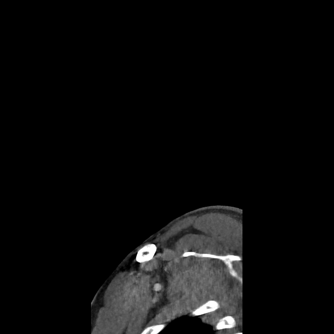 Buccal fat pad arteriovenous malformation (Radiopaedia 70936-81144 C 83).jpg